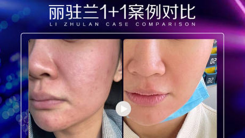 医美咨询师加盟，区域保护背后的行业考量