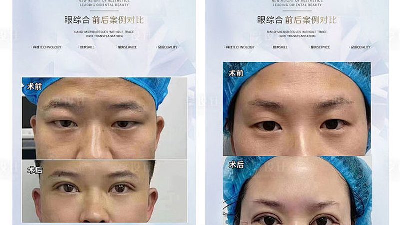 注射隆鼻与手术隆鼻：安全选择的关键因素