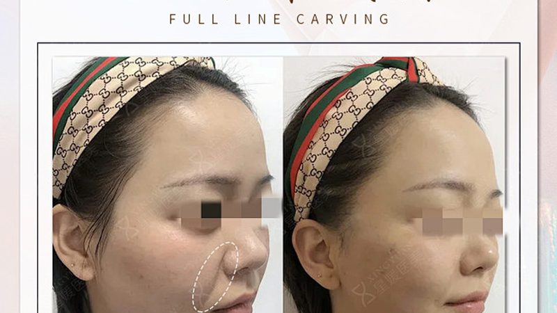 隆鼻术后如何正确佩戴眼镜，加速恢复？**
