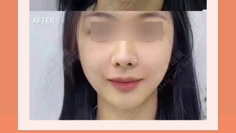 成都肋软骨隆鼻：揭秘适合人群与注意事项