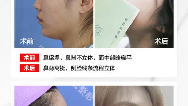 肉毒素注射后洗脸，会影响效果吗？**