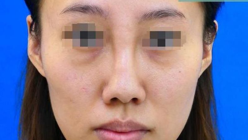 激光祛斑后多久可以化妆？揭秘祛斑恢复期